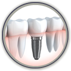 Dental Implants Tecumseh