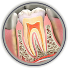 Root Canal Treatment Tecumseh